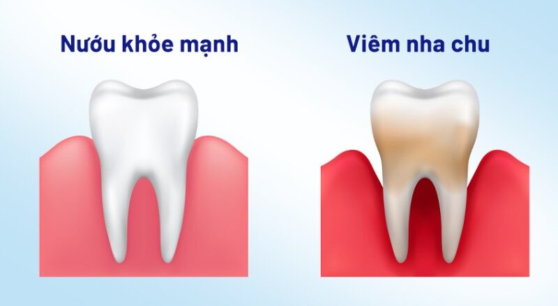 Viêm nha chu bắt đầu từ những mảng bám chứa đầy vi khuẩn trên răng