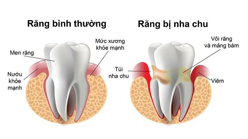 Vi khuẩn có hại trong vôi răng, mảng bám dẫn đến các bệnh viêm nha chu